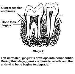 Gum Disease