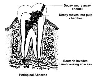 Periapical Abscess